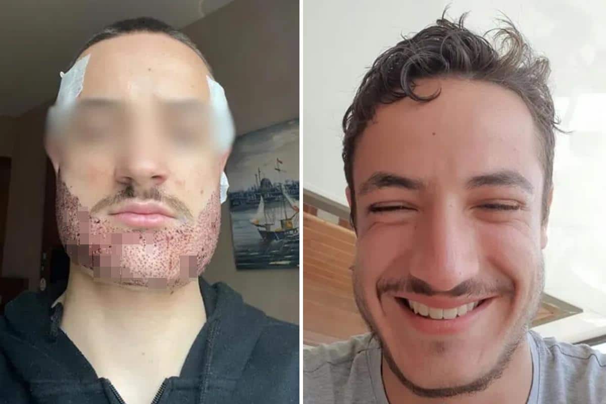 OTIŠAO U TURSKU NA TRANSPLANTACIJU BRADE, A ČETIRI MESECA KASNIJE SE UBIO: Priča o mladiću (24) koja je potresla svijet – otkrivena strašna tajna o hirurgu koji ga je operisao.