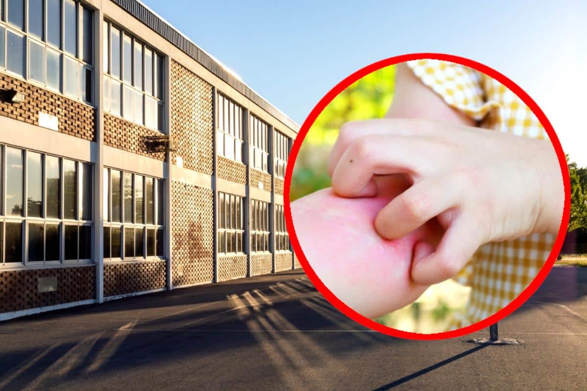 Šok slučaj u Beogradu, hara opaka zaraza! Prvak od svraba popustio u školi, roditelji mislili da je alergija: Lekar objasnio – Odmah sam znao šta je u pitanju