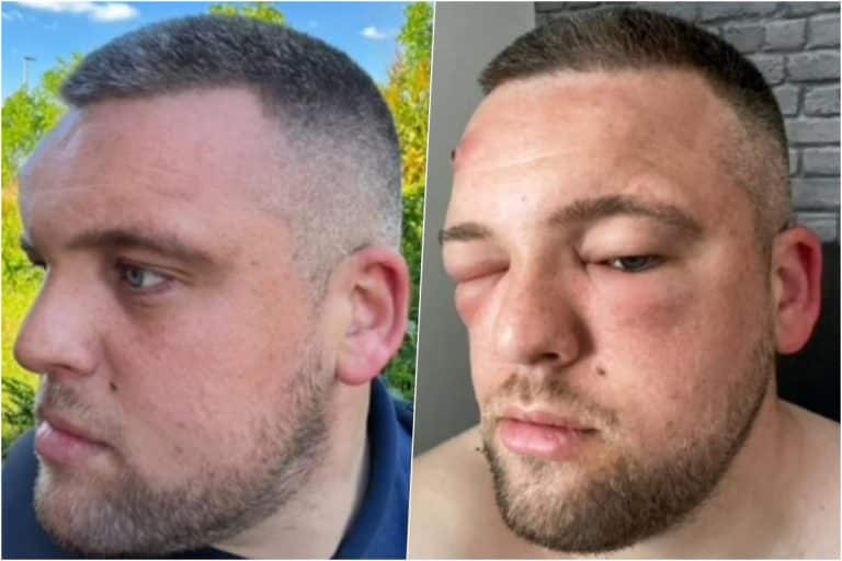 “Nešto mi je iskočilo iz čela i počelo da se koprca”: Mislio da je bubuljica, cedio je, a kad su mu se zatvorila oba oka  u bolnici se šokirao