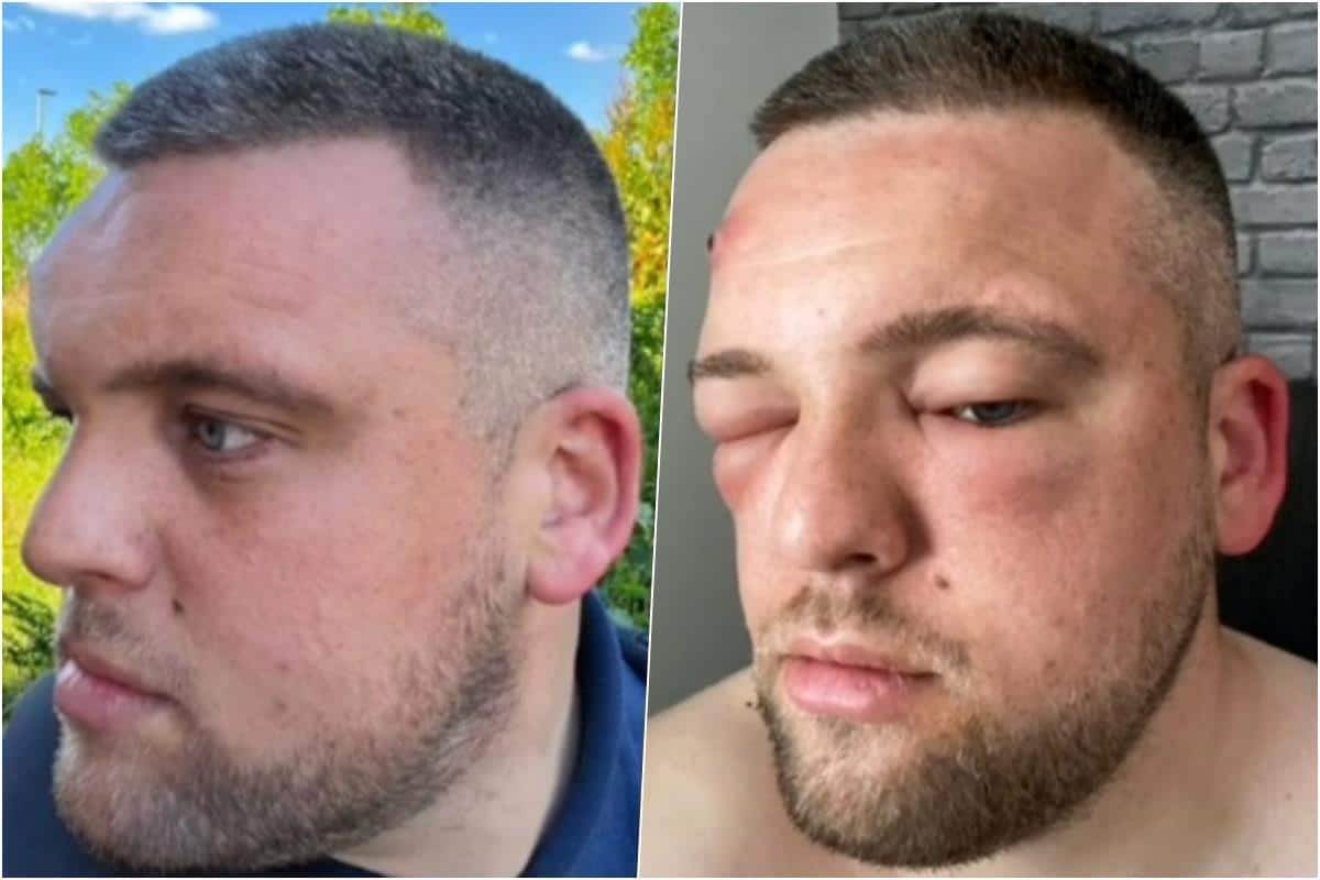“Nešto mi je iskočilo iz čela i počelo da se koprca”: Mislio da je bubuljica, cedio je, a kad su mu se zatvorila oba oka u bolnici se šokirao