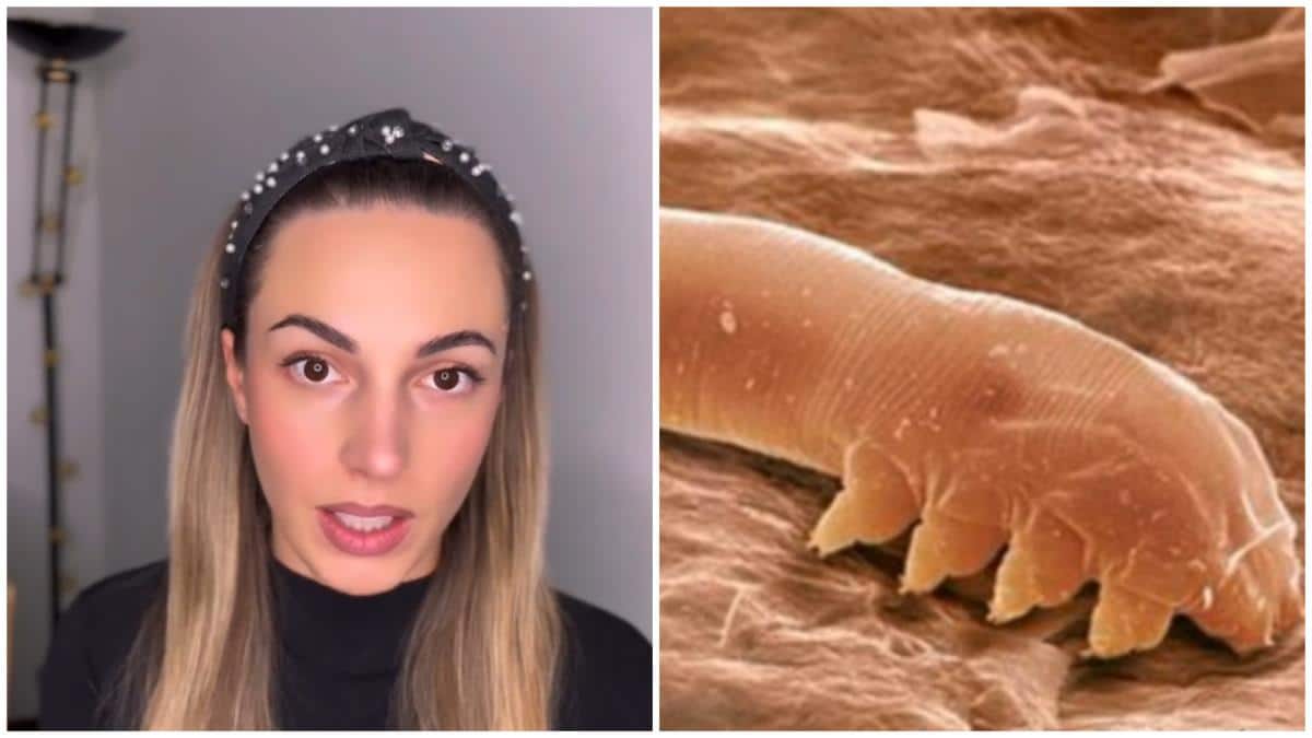 Jeleni se na licu pojavio osip i crvenilo, niko nije znao šta joj je, a onda šok! Bris je pokazao da joj se na koži dve godine razmnožava ovaj jezivi parazit!