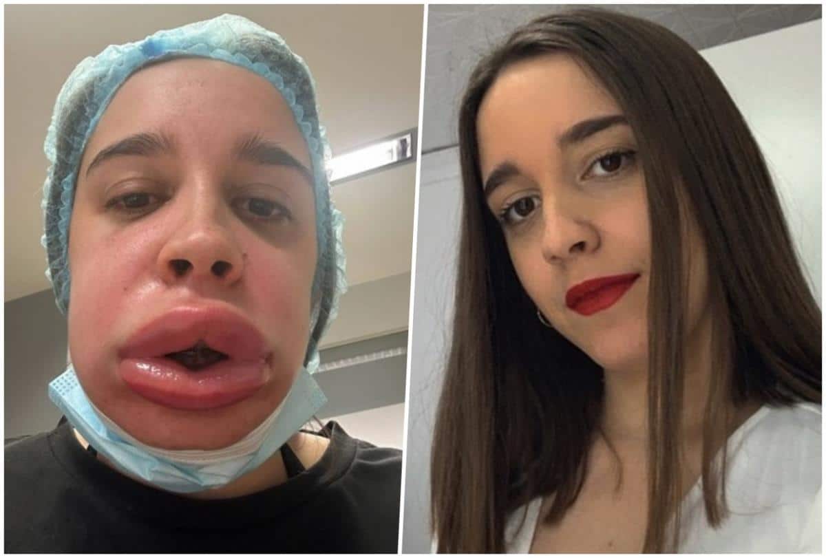 “Otišla sam da uklonim filere iz usana, sad me zovu žaba krastača” Sara zbog estetske korekcije prošla horor, pa završila u bolnici (FOTO)